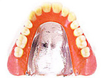 金属床義歯（コバルト）