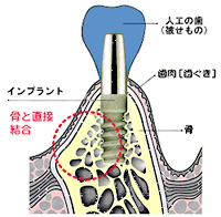 インプラント治療とは？